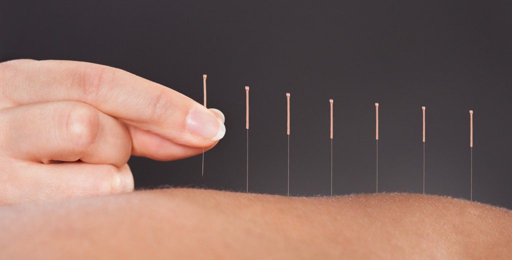 acupuncture-anxiety